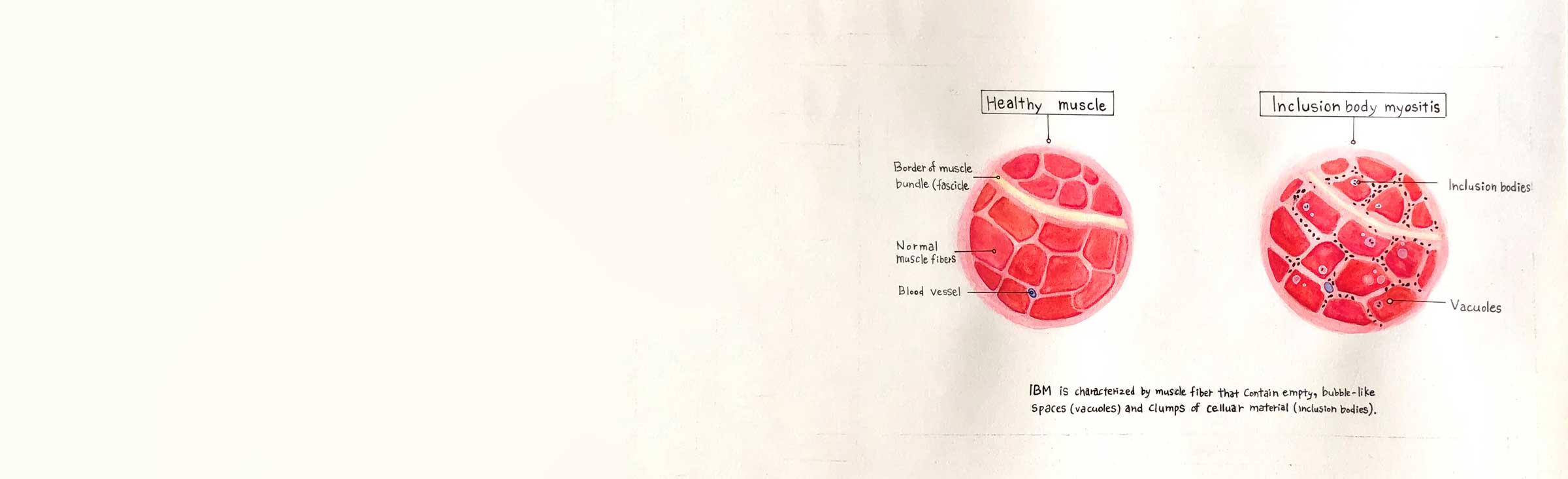 Bed band exercises - Myositis Association Australia