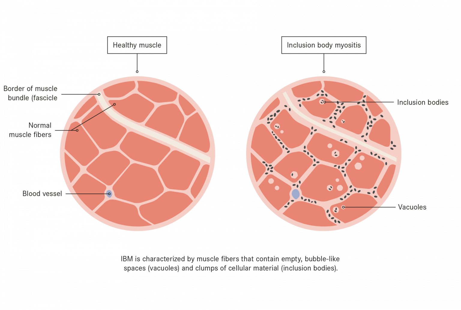 Is Viral Myositis Dangerous